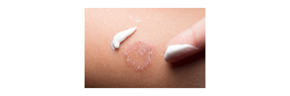 Lokaltherapien: Cremes gegen Schuppenflechte im Überblick - Ayurvedische Repair Creme bei Schuppenflechte | Ruhe Healthcare GmbH