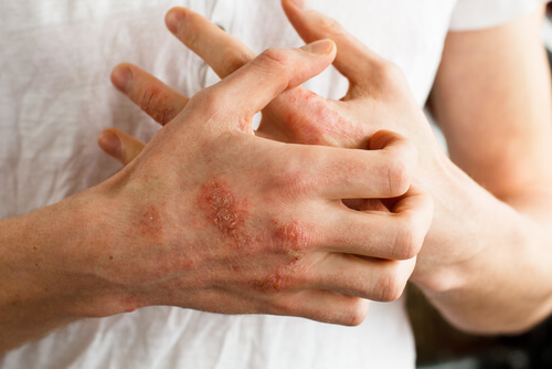 Abbildung von zwei Händen mit der Hautkrankheit Schuppenflechte