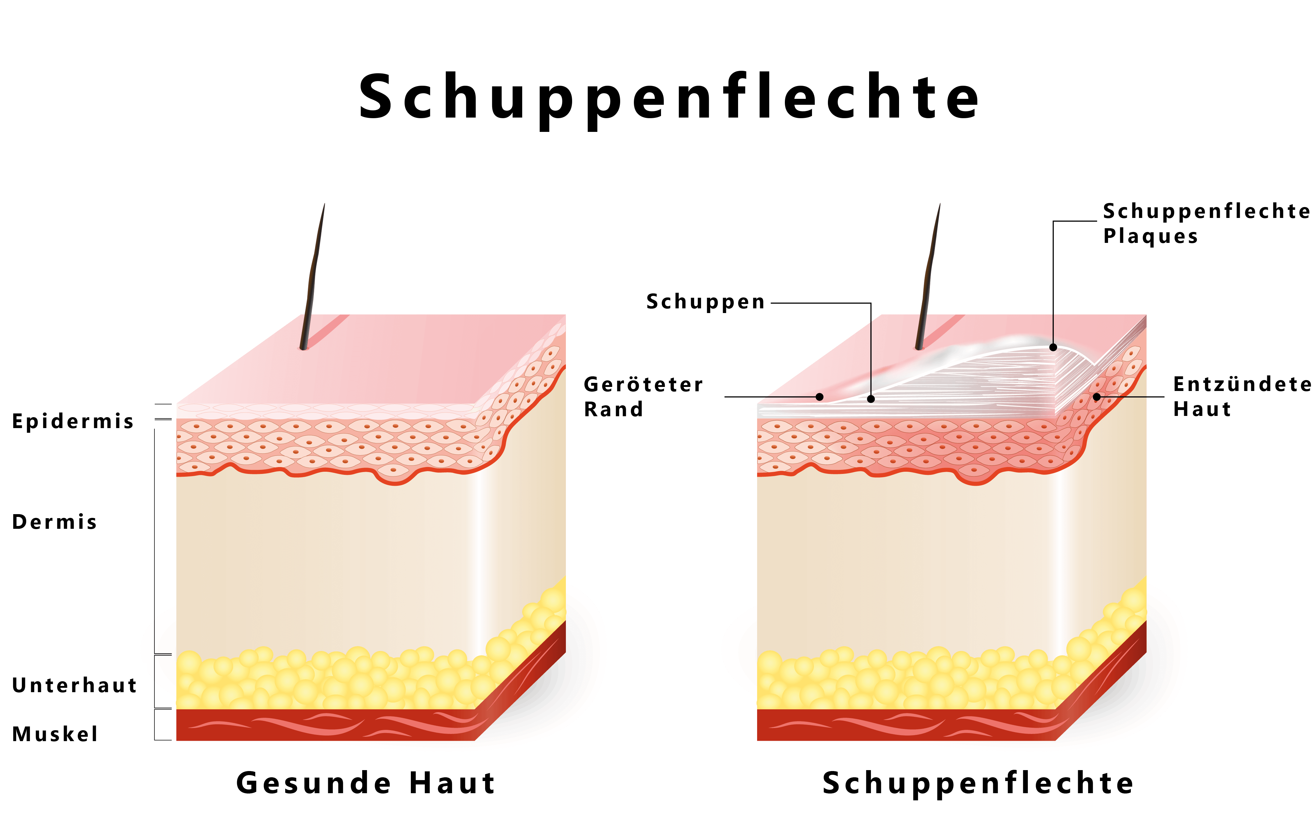 Grafische Abbildung einer gesunden Haut und einer Haut mit Schuppenflechte